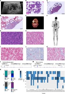 Case report: ‘Atypical Richter transformation from CLL-type monoclonal B-cell lymphocytosis into Burkitt lymphoma in a treatment naïve patient’